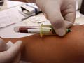 44 year old man dies of swine flu in Tamil Nadu