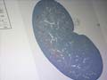 Lab-made rat kidneys raise hopes for dialysis patients