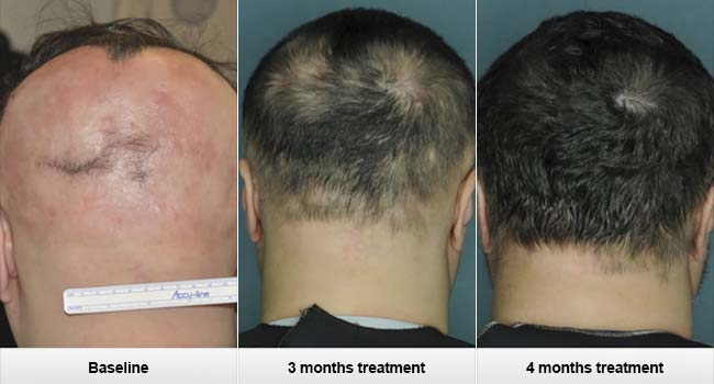 Alopecia Areata  The End of Hair Loss and Balding by 2020