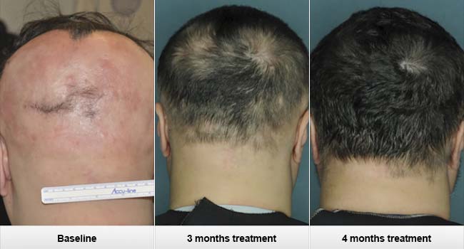 Ruxolitinib Alopecia Areata