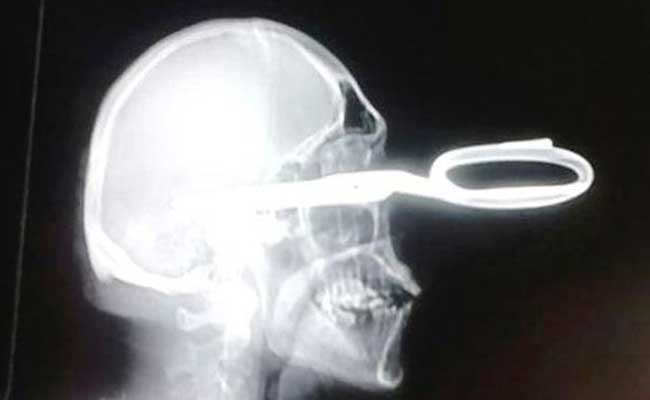 Man with Scissors Lodged in Head Politely Asks for Help Man with Scissors Lodged in Head Politely Asks for Help