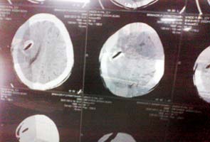 wood_brain_CTscan_295.jpg