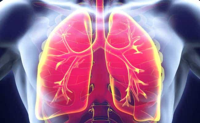 Pulmonary fibrosis can develop after lung injuries like infection, chemotherapy or radiation
