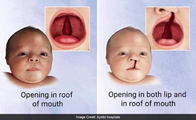 The findings showed that there are 72,637 cases of unrepaired cleft lip and palate in India.