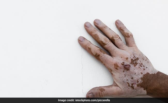 World Vitiligo Day 2021: Know About The Causes Of This Skin Disorder