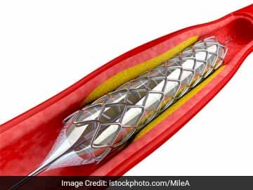 The recent reduction in the price of cardiac stents has brought relief to lakhs of patients.
