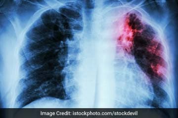 Tuberculosis is one of the top 10 causes of death worldwide.