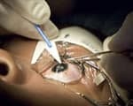 Over the past few years, LASIK has become very popular among people worldwide. It has made an enormous difference to people with near sight, far sight and astigmatism.