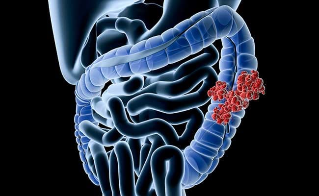 Colon cancer is one of the top 5 common forms of cancer