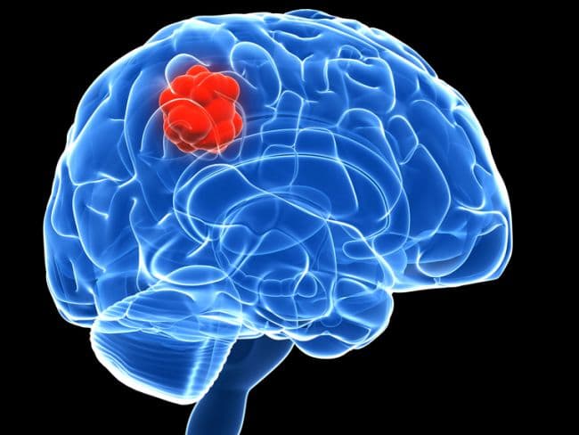 The virus could act as an effective immunotherapy in patients with brain cancer that spreads