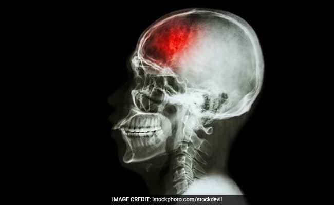 World Stroke Day: A stroke happens when the supply of blood to the brain is restricted