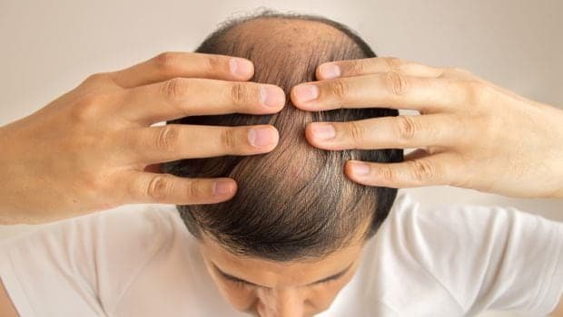 Male pattern baldness refers to hair loss in men in a particular pattern