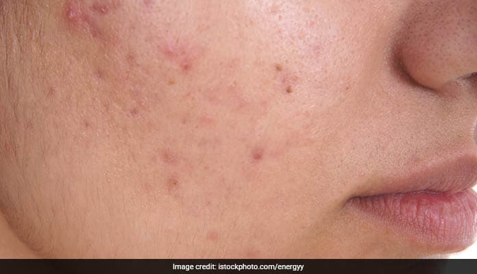 Excess sebum secretion by the oil glands is the primary cause behind this problem