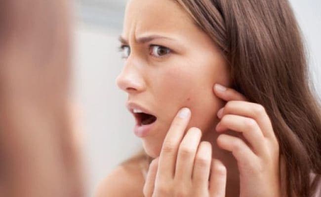 Teenage acne: nutrition hacks to deal with it