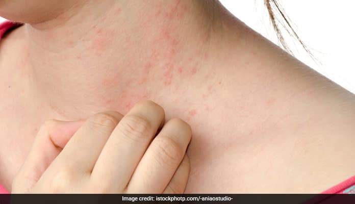 Eczema is a medical condition in which patches of skin become rough and inflamed