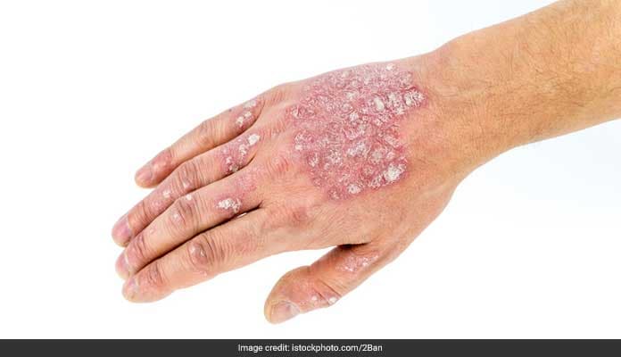 Ditch The Ointments And Try These Amazing Ayurvedic Remedies For Psoriasis