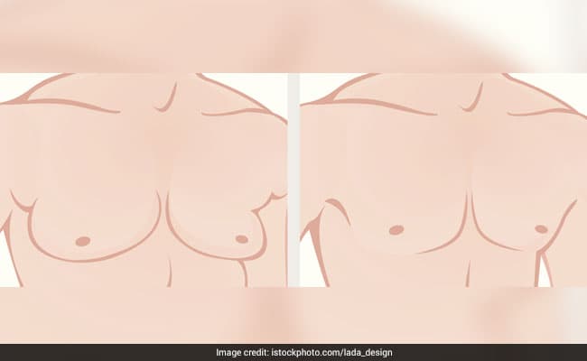 Best 3 ways to get rid of male breasts