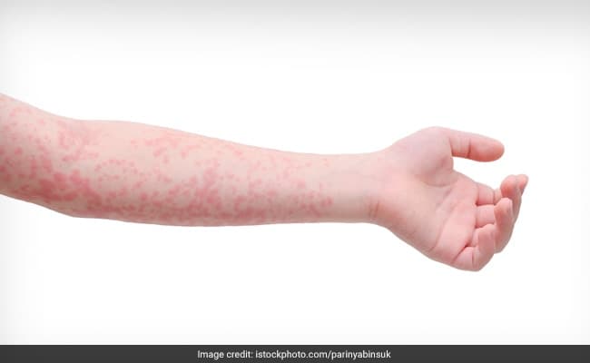 Petechiae is not an unsual condition of the skin