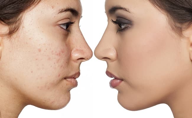 Foods to avoid to prevent acne