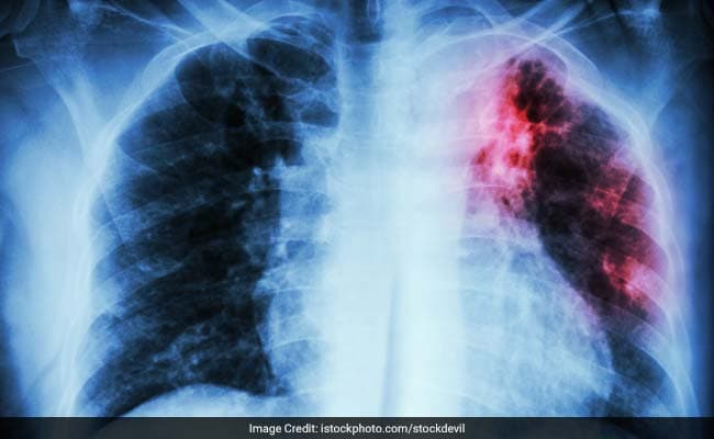 TB affects all and is everybody's business