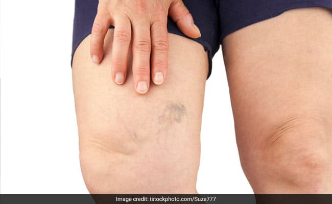 Swelling if not severe, is one of the symptoms of tetanus shot