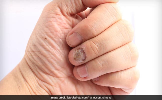 Candida can affect both men and women of all age groups
