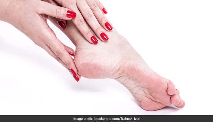 Cracked heels are a common problem that causes a lot of pain and discomfort to the sufferer