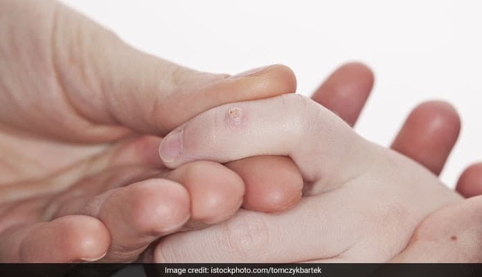 While surgical removal is preferred by doctors, you can get rid of your warts naturally