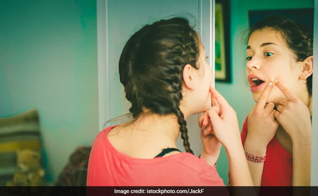 Blackheads are a mild form of acne which cannot be seen from a distance