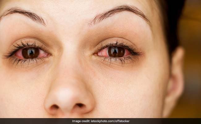 Conjunctivitis In Babies: Know Signs, Symptoms And Treatment Options