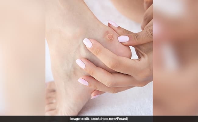 Home remedies for corns and calluses: They can make life quite miserable for you