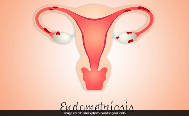 Here's How And Why Endometriosis Silently Kills Chances Of Motherhood And Getting Pregnant