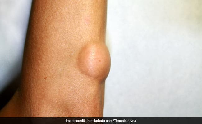 Lipomas: What Are Lipomas And How To Treat Them Naturally