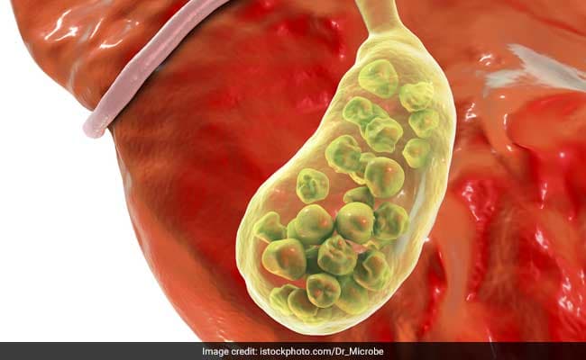 Gallstone Diet: 6 Easy Foods That Prevent Gallstones