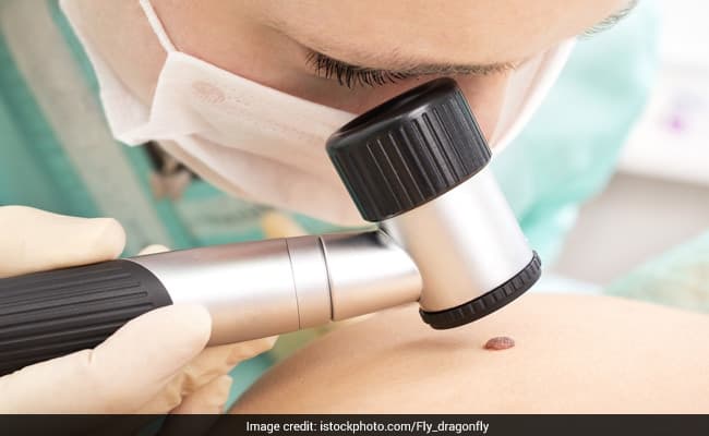 It is quite rare that moles become cancerous