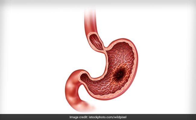 Stomach cancer does not show many symptoms in the early stages