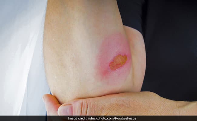 These home remedies for skin burn will help in providing instant relief