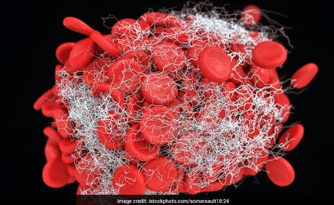 Thalassemia: People with thalassemia produce less healthy haemoglobin proteins