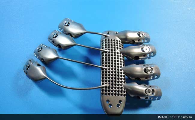 The team had manufactured the implant out of surgical grade titanium alloy.