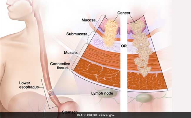 Scientists discovered a rare genetic mutation linked to oesophageal cancer. (Representational)