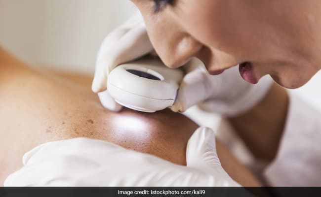 Is Skin Cancer In India More Prominent Than Ever?