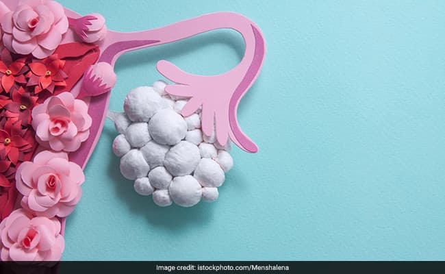 PCOS Vs Endometriosis: Understanding The Difference Between The Two And Effect On Fertility