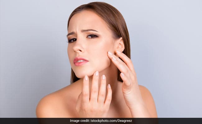 Skincare: What Are Acne Scars? Know Treatment Options