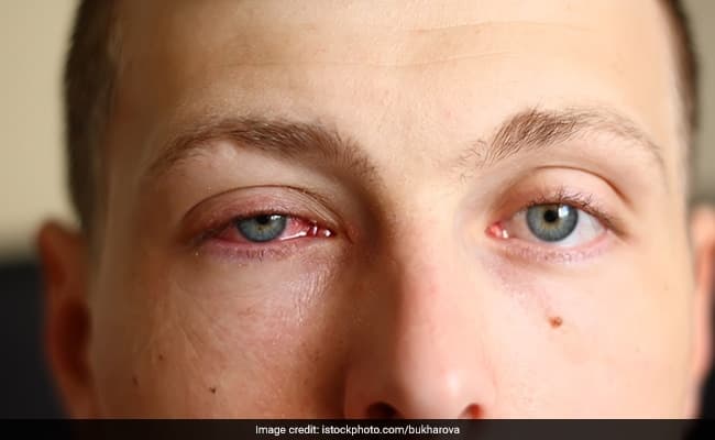 Eye Health: Constantly Rubbing Your Eye? This Could Be Why