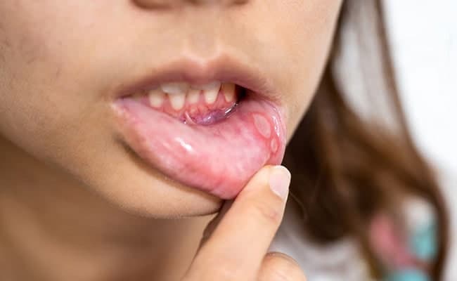 How To Cure Mouth Ulcers Naturally