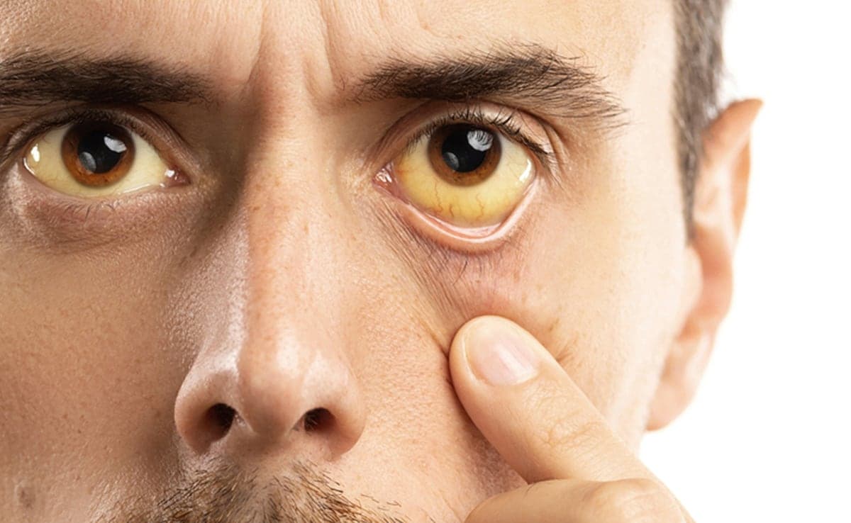 7 Early Signs And Symptoms Of Liver Disease You Shouldn't Ignore