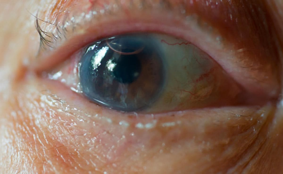 Cataracts: Watch Out For These Myths If You Wish To Get Operated