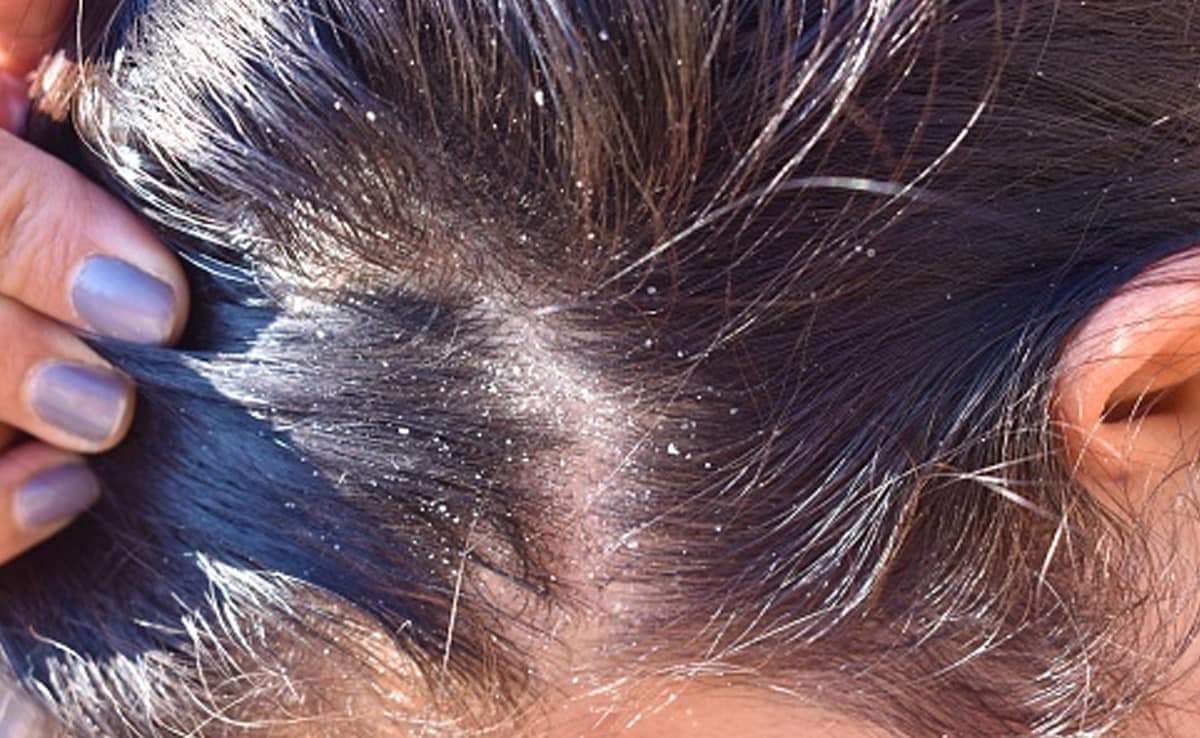 Experiencing Dandruff As The Weather Changes? Follow These Tips For Relief