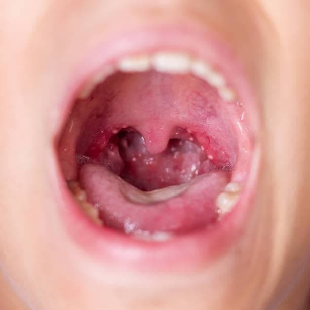 What Is Tonsil Stone: All You Need To Know About Tonsillotiths