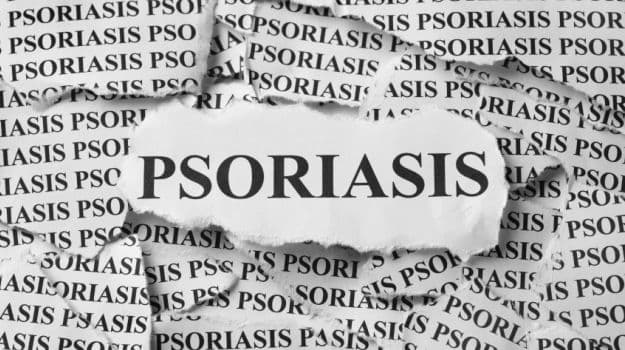 Scalp psoriasis is a skin disorder characterized by red, scaly patches on the scalp